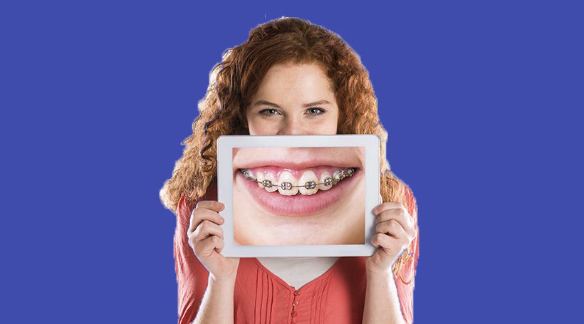 Busting 5 Myths About Braces Sj Magazine